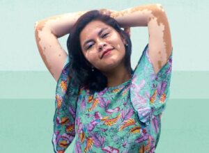 Vitiligo on the Lips: Why It Happens and the Latest Treatment Options in India, Explains Kayakalp Global