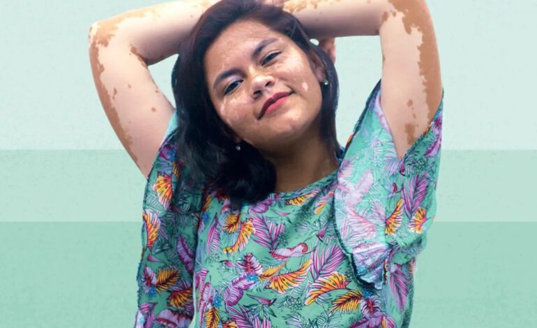 Vitiligo on the Lips: Why It Happens and the Latest Treatment Options in India, Explains Kayakalp Global