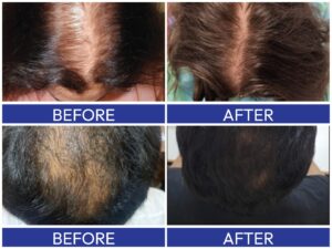 QR678 secures new Indian patent for integrated hair regeneration kit