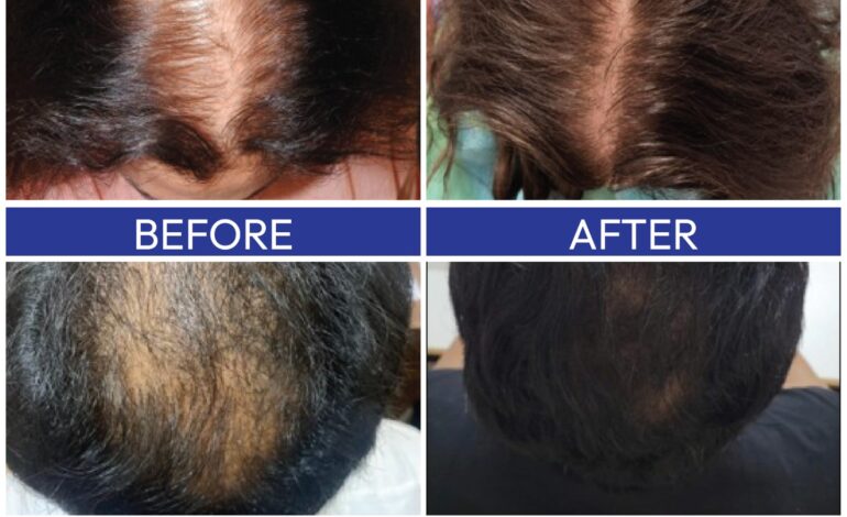 QR678 secures new Indian patent for integrated hair regeneration kit