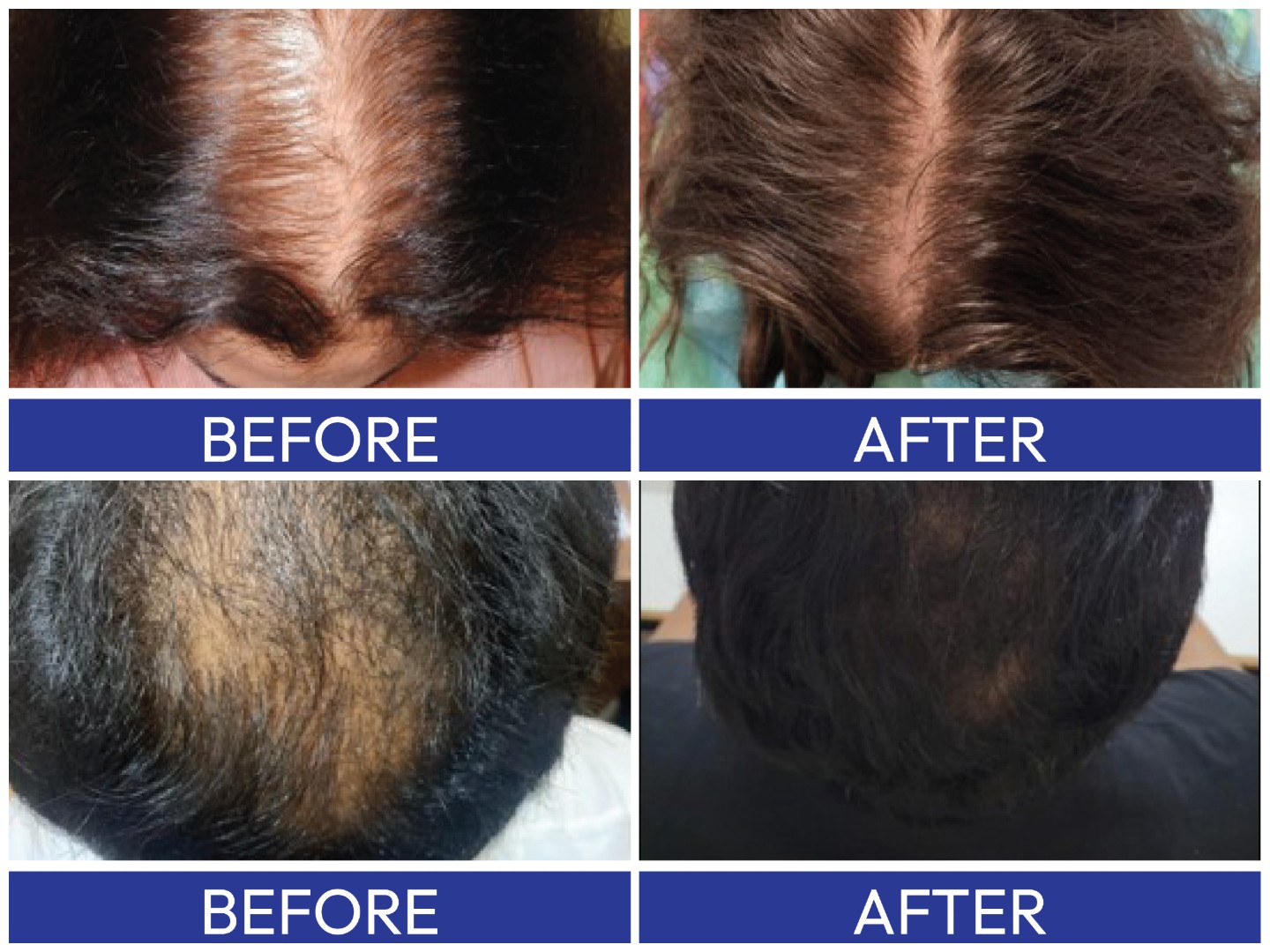 QR678 secures new Indian patent for integrated hair regeneration kit